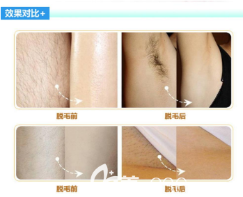 脫毛的效果對(duì)比圖