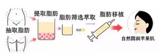 脂肪填充面部的手術(shù)流程