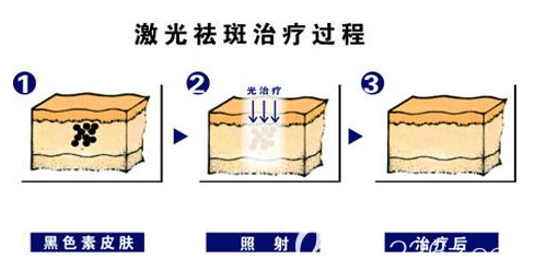 激光祛斑治療過(guò)程