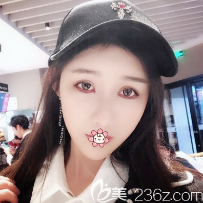 佛山華美祛眼袋術(shù)后10天效果圖 佛山華美祛眼袋術(shù)后10天效果圖