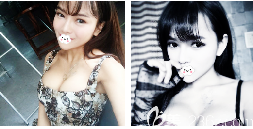 東莞美立方做玉兔動(dòng)感隆胸怎么樣 東莞美立方做玉兔動(dòng)感隆胸怎么樣