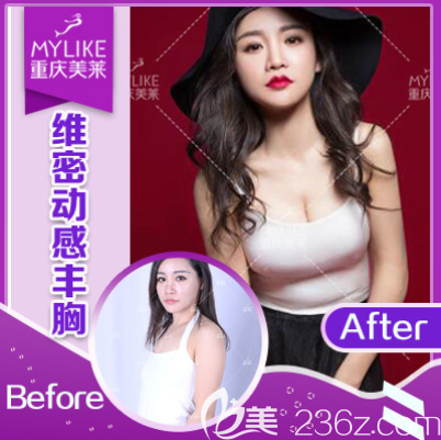 重慶美萊吳繼東隆胸案例 重慶美萊吳繼東隆胸案例