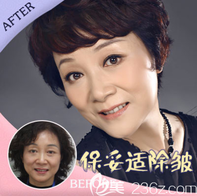 張東梅除皺 張東梅除皺