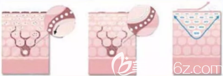 激光去紅血絲治療原理示意圖