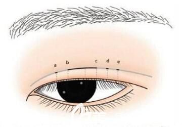 全切雙眼皮多久能修復(fù)