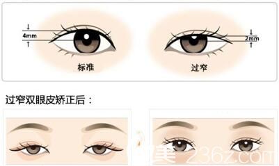 全切雙眼皮修復(fù)術(shù)后注意事項(xiàng)