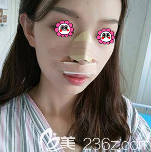 黃海濱醫(yī)生給我做耳軟骨隆鼻第3天樣子