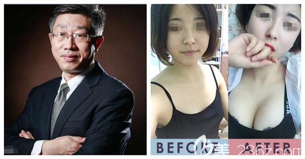 <!--<i data=20240703-sp></i>-->主任醫(yī)師自體脂肪隆胸對比照 <!--<i data=20240703-sp></i>-->主任醫(yī)師自體脂肪隆胸對比照