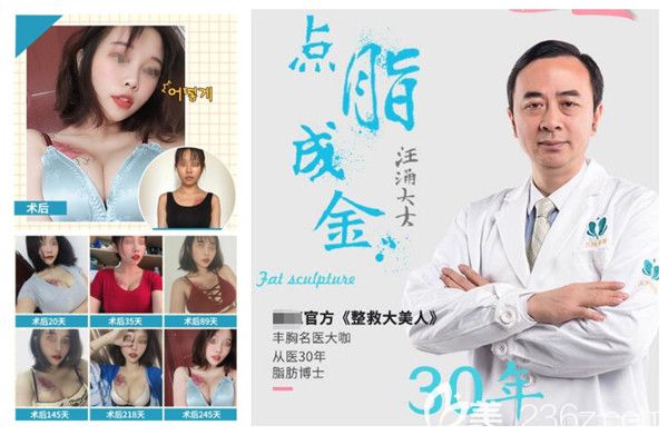 汪涌醫(yī)生隆胸案例 汪涌醫(yī)生隆胸案例