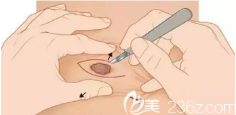 激光點(diǎn)痣過程圖解