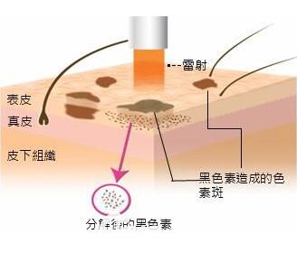 激光祛斑的過程原理解析