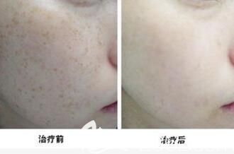激光祛斑多少錢？前后效果對比照片