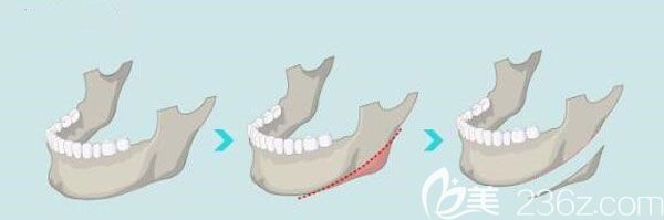 下頜角整形手術(shù)