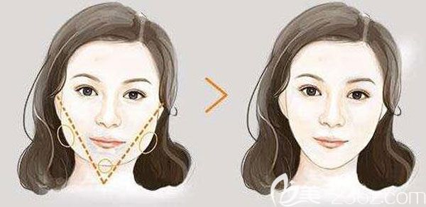 下頜角手術(shù)可以做2次嗎