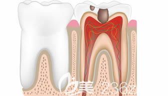 王入義醫(yī)生科普牙髓炎知識
