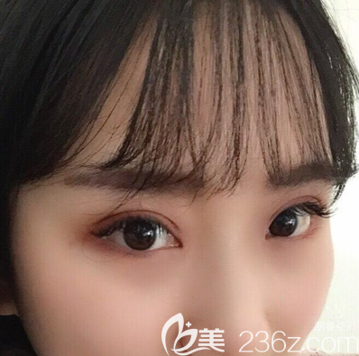 以前的三角眼，在張玲做完雙眼皮開眼角手術(shù)后再也不兇了