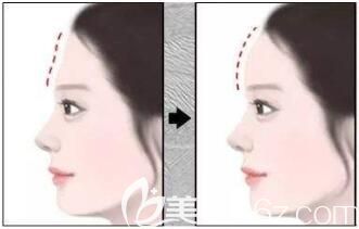 假體豐額頭手術(shù)過程