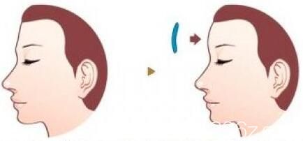 假體豐額頭安全嗎？