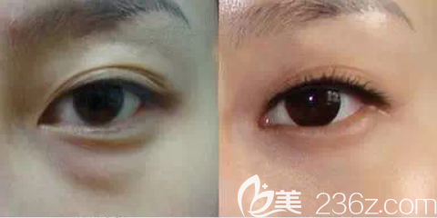 祛眼袋術(shù)前術(shù)后效果對(duì)比