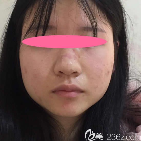 我做鼻頭縮小6個月增生了的真實圖片