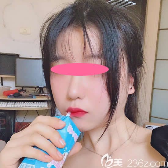 鼻頭增生修復(fù)成功后圖片