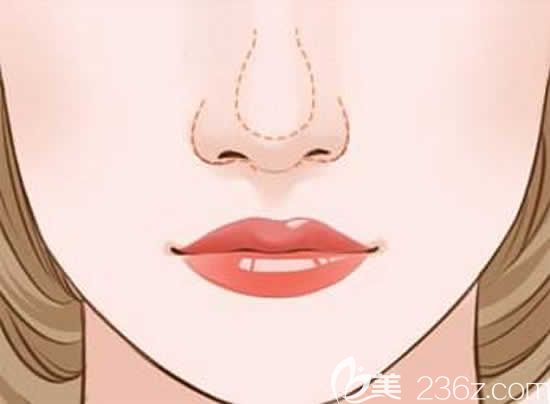 怎么預(yù)防鼻頭縮小術(shù)后增生小妙招