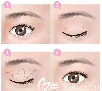 雙眼皮切開的樣子