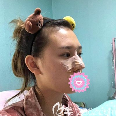 洛陽華美肋骨隆鼻術(shù)后3天 洛陽華美肋骨隆鼻術(shù)后3天