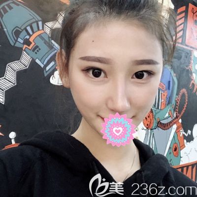 洛陽華美肋骨隆鼻術(shù)后30天 洛陽華美肋骨隆鼻術(shù)后30天