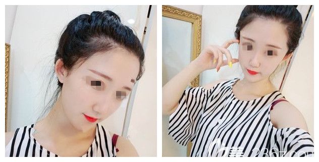 怎么淡斑祛斑?南通李冬穎醫(yī)生面診我和閨蜜的黃褐斑和曬斑建議了輝煌360祛除