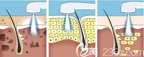 果酸換膚副作用