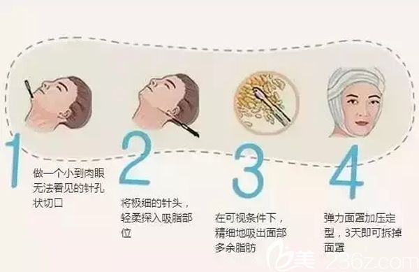臉部抽脂原理圖
