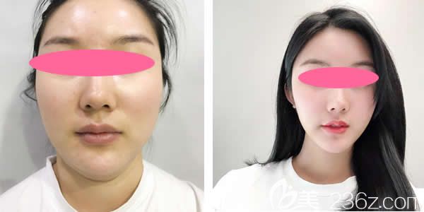 真人案例面部吸脂做完10天圖片