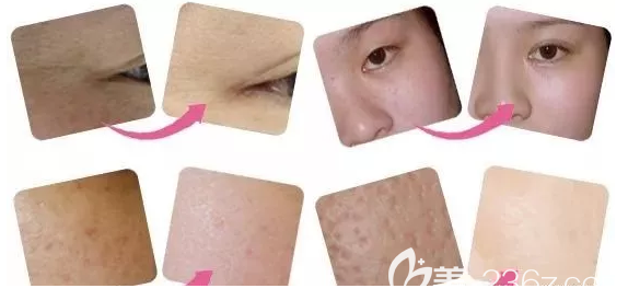 光子嫩膚效果展示