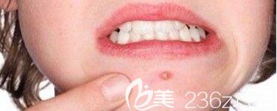 網(wǎng)友發(fā)來咨詢下巴長痘的照片