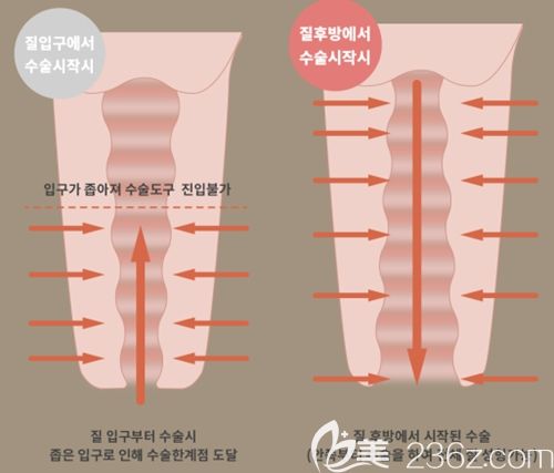韓國好手藝后方膣圓蓋術(shù)