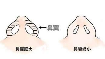 鼻翼縮小術前術后對比效果