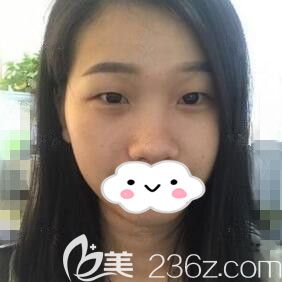 做眼鼻綜合術(shù)前照 做眼鼻綜合術(shù)前照