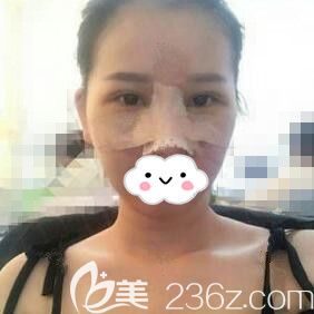 做眼綜合+鼻綜合術(shù)后第3天 做眼綜合+鼻綜合術(shù)后第3天