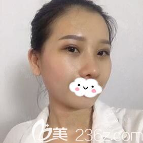 在華美做眼綜合+鼻綜合術(shù)后第8天恢復(fù)效果 在華美做眼綜合+鼻綜合術(shù)后第8天恢復(fù)效果