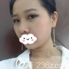 在海南華美做眼鼻綜合術(shù)后25天恢復(fù)照 在海南華美做眼鼻綜合術(shù)后25天恢復(fù)照