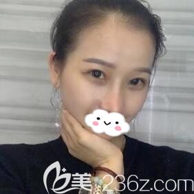 還在糾結(jié)鼻綜合和眼綜合要不要一起做，看我在海南華美做的效果變化不要太大哦！