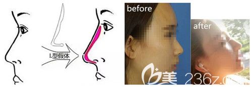 硅膠假體隆鼻手術(shù)效果好還安全