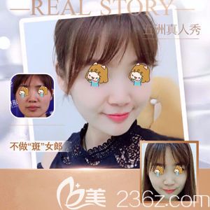 五洲萊美做超皮秒祛斑術(shù)后皮膚白凈