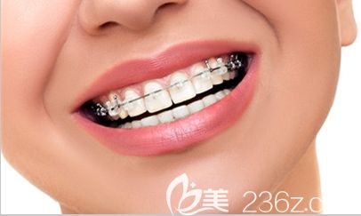 姜丹醫(yī)生帶大家解開有關牙齒矯正的謠言 姜丹醫(yī)生帶大家解開有關牙齒矯正的謠言