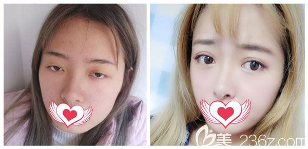 汪妍做全切雙眼皮+開眼角案例效果對比圖