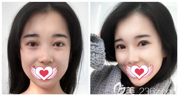 戴巍做肋軟骨隆鼻+耳軟骨墊鼻尖案例