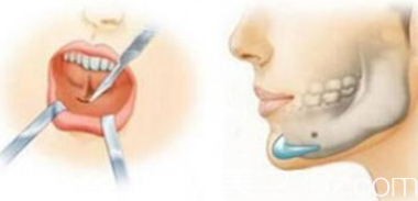 假體墊下巴手術(shù)示意圖