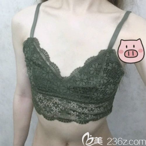 西寧時光整形王雙余給我做曼托260cc水滴形假體隆胸術前的我 西寧時光整形王雙余給我做曼托260cc水滴形假體隆胸術前的我