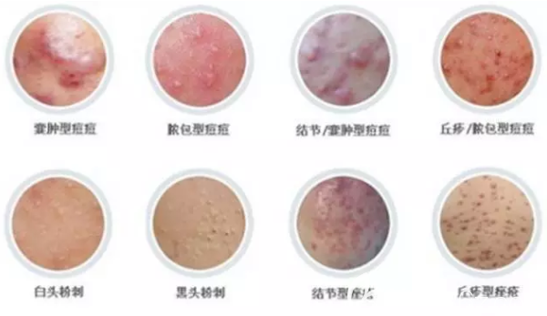 不同程度的痘痘 不同程度的痘痘